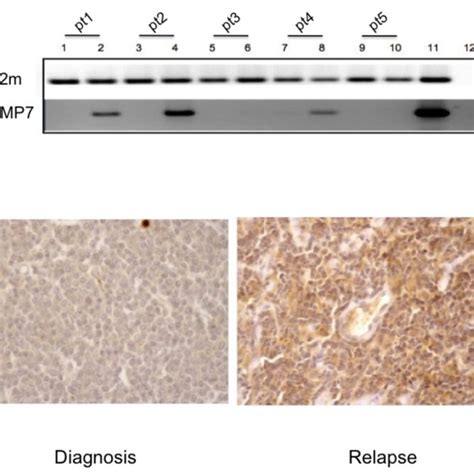 Expression Of BMP7 In MCL Lymphoma Cells Figure 2A From Patients