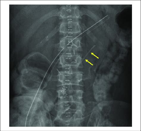 Patient 1 An Abdominal X Ray On Postoperative Day 3 Done To Assess