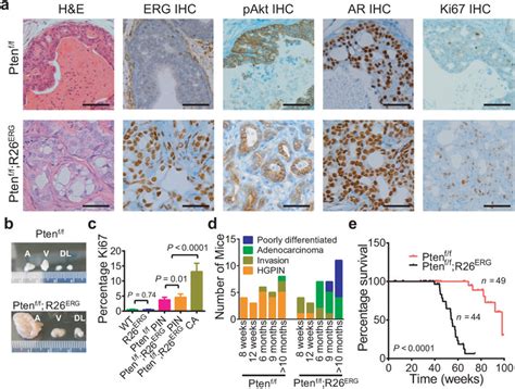 Erg Robustly Cooperates With Pten Loss In Prostate Tumorigenesis A