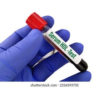 Blood Sample Lipid Profile Triglyceride Hdl Stock Photo 2256593735