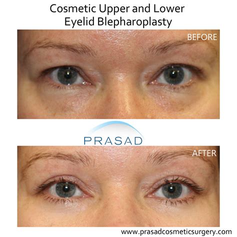 How Long Does Blepharoplasty Last Dr Amiya Prasad Blog