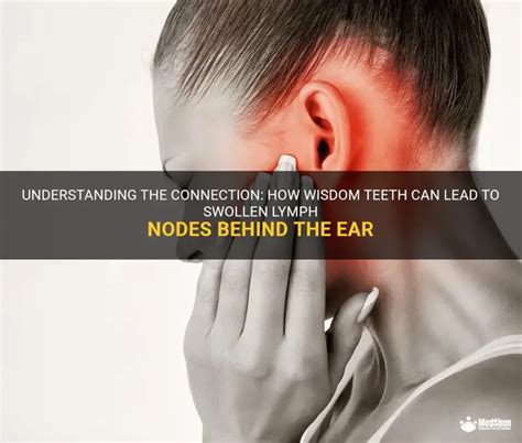 Understanding The Connection: How Wisdom Teeth Can Lead To Swollen Lymph Nodes Behind The Ear ...