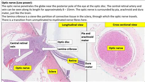 Eye Optic Nerve Nus Pathweb Nus Pathweb