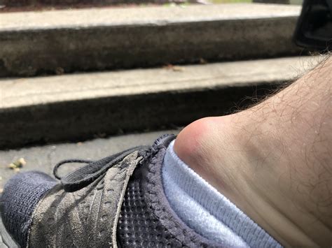 Bursitis. Does this need to be drained? (Doctor said to wait 2 weeks