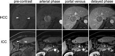 Advances In The Treatment Of Intrahepatic Cholangiocarcinoma An