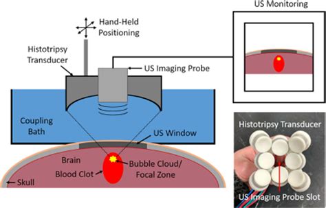 Transcranial Histotripsy Clot And Tissue Ablation For Intracerebral