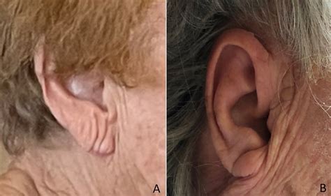 Earlobe Creases