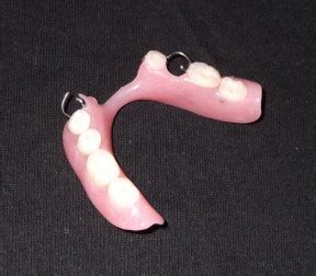 Denture Info: Acrylic Partial Denture - Part II