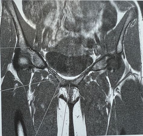 Coronal T1 Pelvis Diagram Quizlet