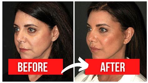 Botox Brow Lift All You Need To Know