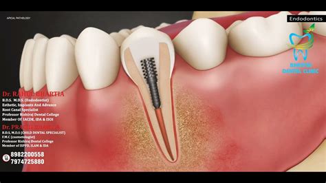 Apical Pathology And Root Canal Endodontics Understanding