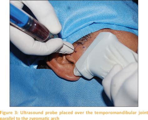 Figure From Ultrasound Guided Autologous Blood Injection In Patients