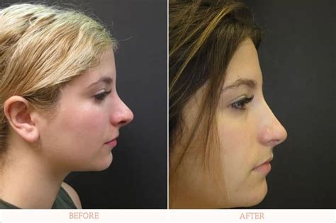 Rhinoplasty Dr Carlos Wolf Miami Plastic Surgery