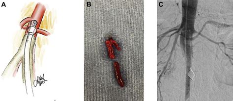 Hybrid Repair For Acute Aortic Occlusion Using Aortobifemoral Bypass