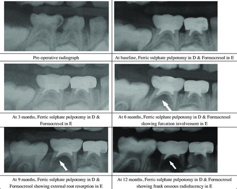 Radiographs Of Formocresol And Ferric Sulphate Pulpotomy At Different