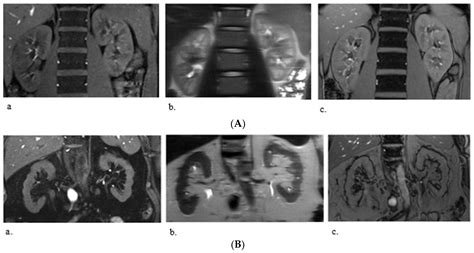 Magnetic Resonance Imaging to Diagnose and Predict the Outcome of