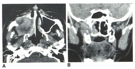 Figure 6 from Pterygopalatine Fossa CT of Perineural Tumor Extension: | Semantic Scholar