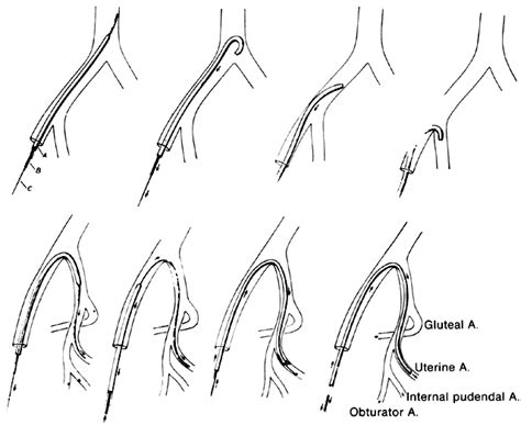 Easy Way To Draw Internal Iliac Branches Englehart Landeat