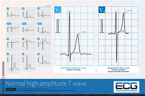 Healthy young and middle-aged men can exhibit normal high amplitude T ...