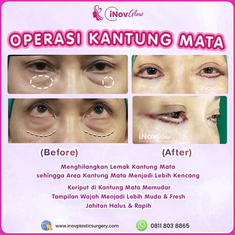 Before After Operasi Kantung Mata Inovglow Klinik Spesialis Bedah