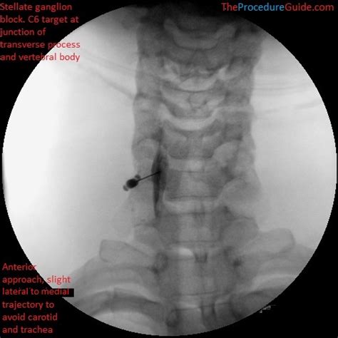 Fluoroscopic Guided Stellate Ganglion Block - Technique and Overview ...