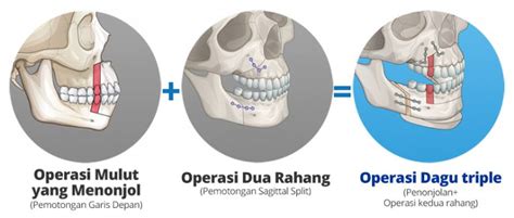 Operasi Dua Rahang Pria Di Korea Rahang 【id Hospital】