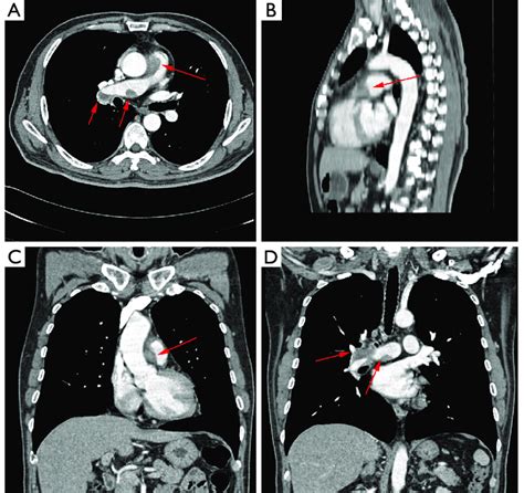 Pulmonary Trunk Ct Scan