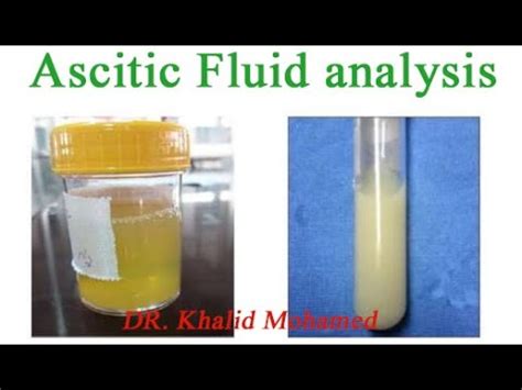 Ascitic fluid analysis تحليل السائل البريتوني YouTube