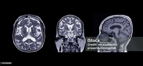 Comparison Mri Of The Brain Axial Coronal Sagittal Plane For Detect A