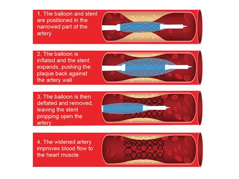 Angioplasty Stents Heart Foundation Nz