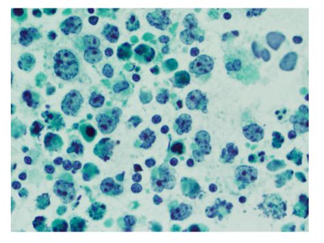 Cap Pleural Fluid Cells Hot Sex Picture