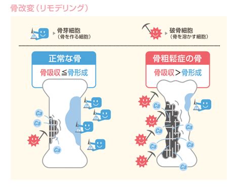 骨粗鬆症（こつそしょうしょう）って何？