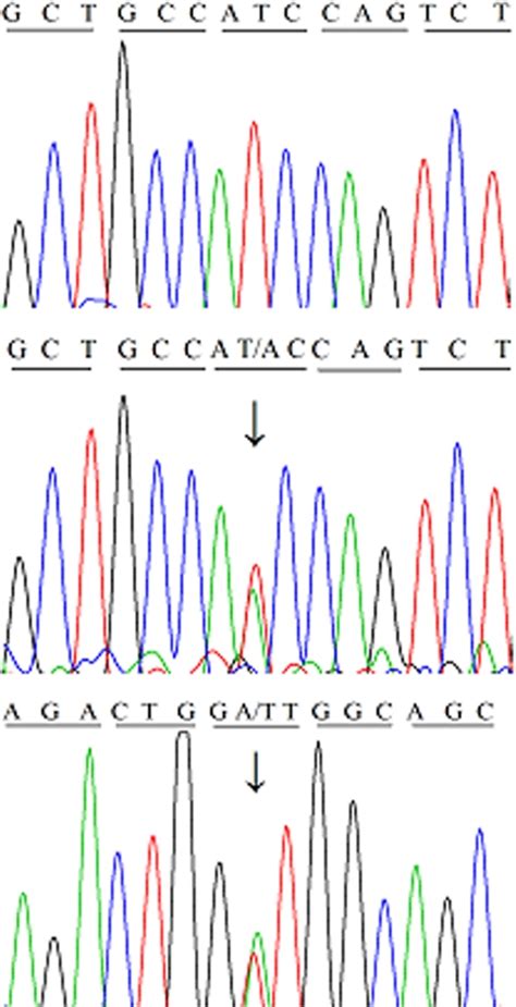 Partial Nucleotide Sequence Of Exon Of Tgfbi In Affected And