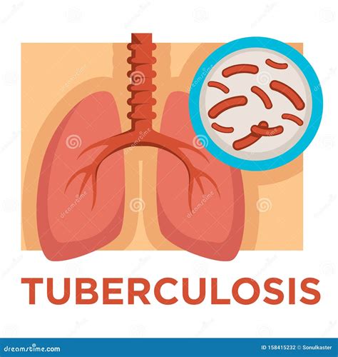 Enfermedad De La Tuberculosis Pulmones Infectados Enfermedad Pulmonar