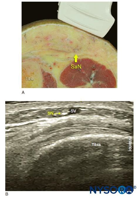 Saphenous Nerve Block Ultrasound