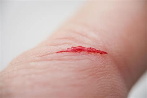 Premium Photo Injured Persons Finger With Bleeding Open Cut Wound