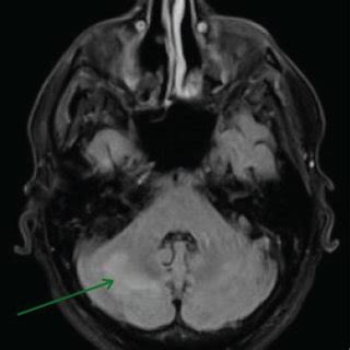 T Flair Magnetic Resonance Imaging Mri Brain With Contrast