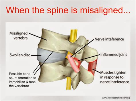 WfLC: SPINAL MISALIGNMENT