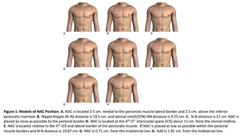 Aaps Crowdsourcing The Ideal Nipple Areolar Complex Nac Position