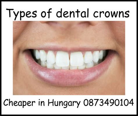 Types of dental crowns - Hungarian Dentists Wexford