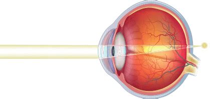 Farsightedness Treatment, Bronx, NY