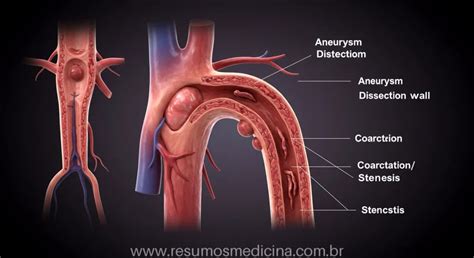 O Que É Dissecção Da Aorta - Doenças da Aorta: Guia Completo sobre Dissecção, Coarctação, Estenose e ...