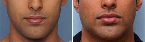 Plastic Surgery Case Study Remove And Replace Custom Jawline Implant