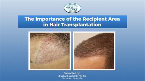 The Importance Of The Recipient Area In Hair Transplantation Surgery Bradley R Wolf Md