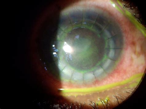 Corneal Transplant Stitches