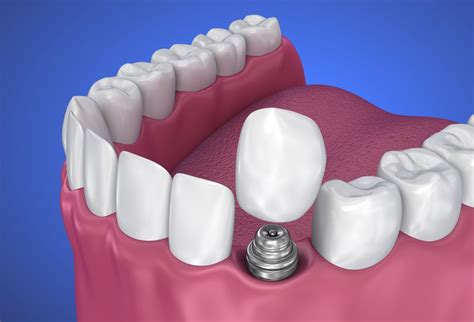 Dental Implants Gosford Central Coast Expert Care