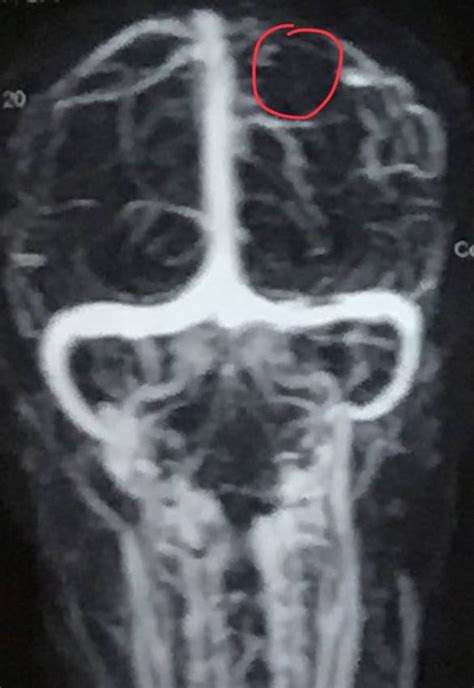 Intracranial Hypotension : MRI - Sumer's Radiology Blog