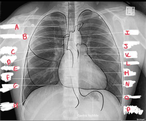 Imaging Of The Chest Flashcards Quizlet