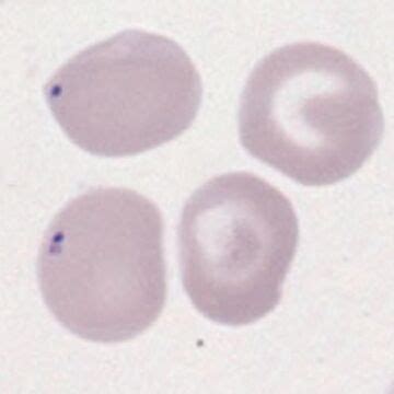 Pappenheimer Bodies - haematologyetc.co.uk