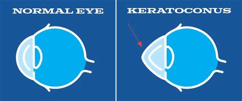 Corneal Crosslinking Cxl For Keratoconus Explained Erik Anderson Md